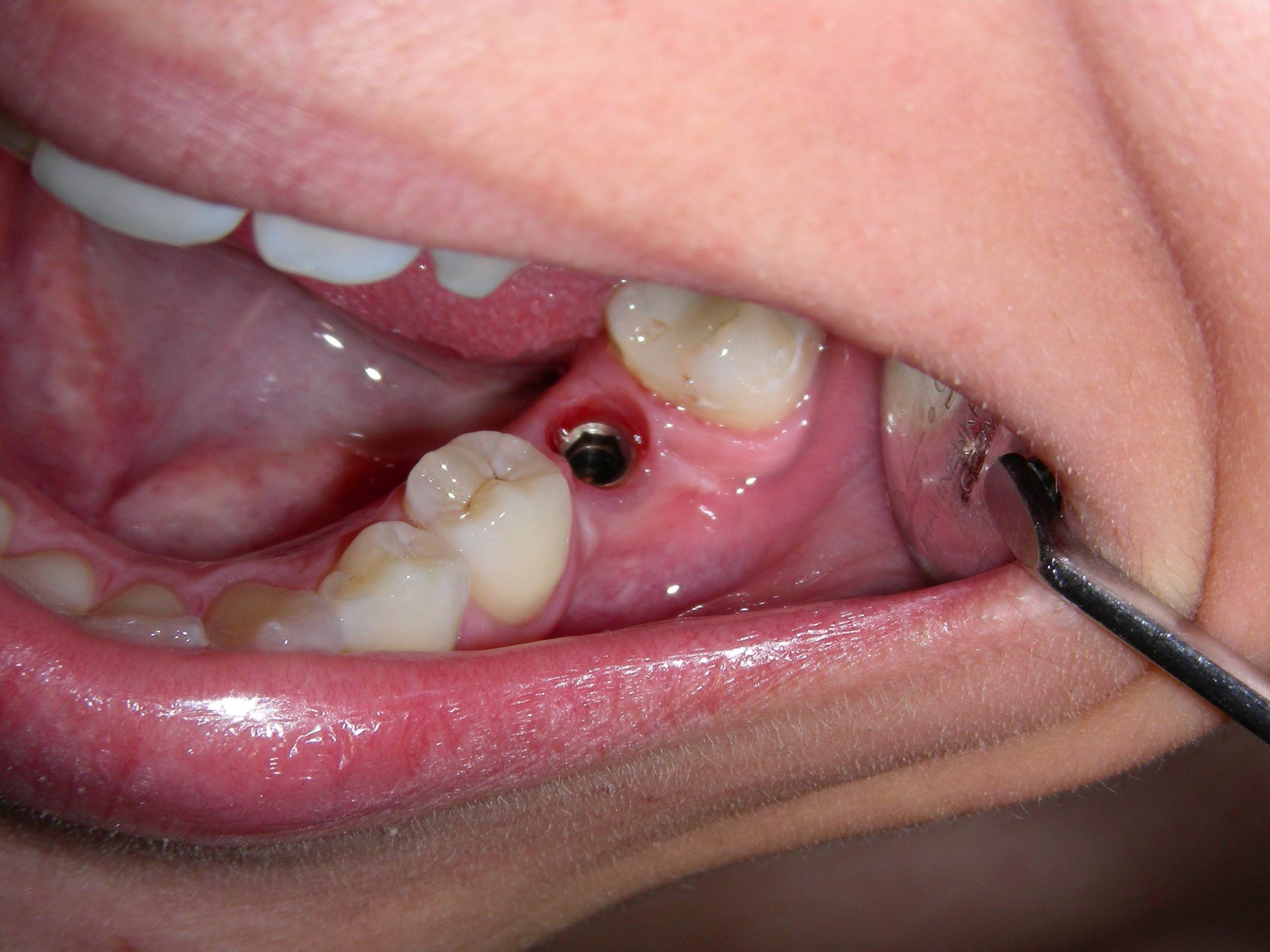 Porcelain crown on implant